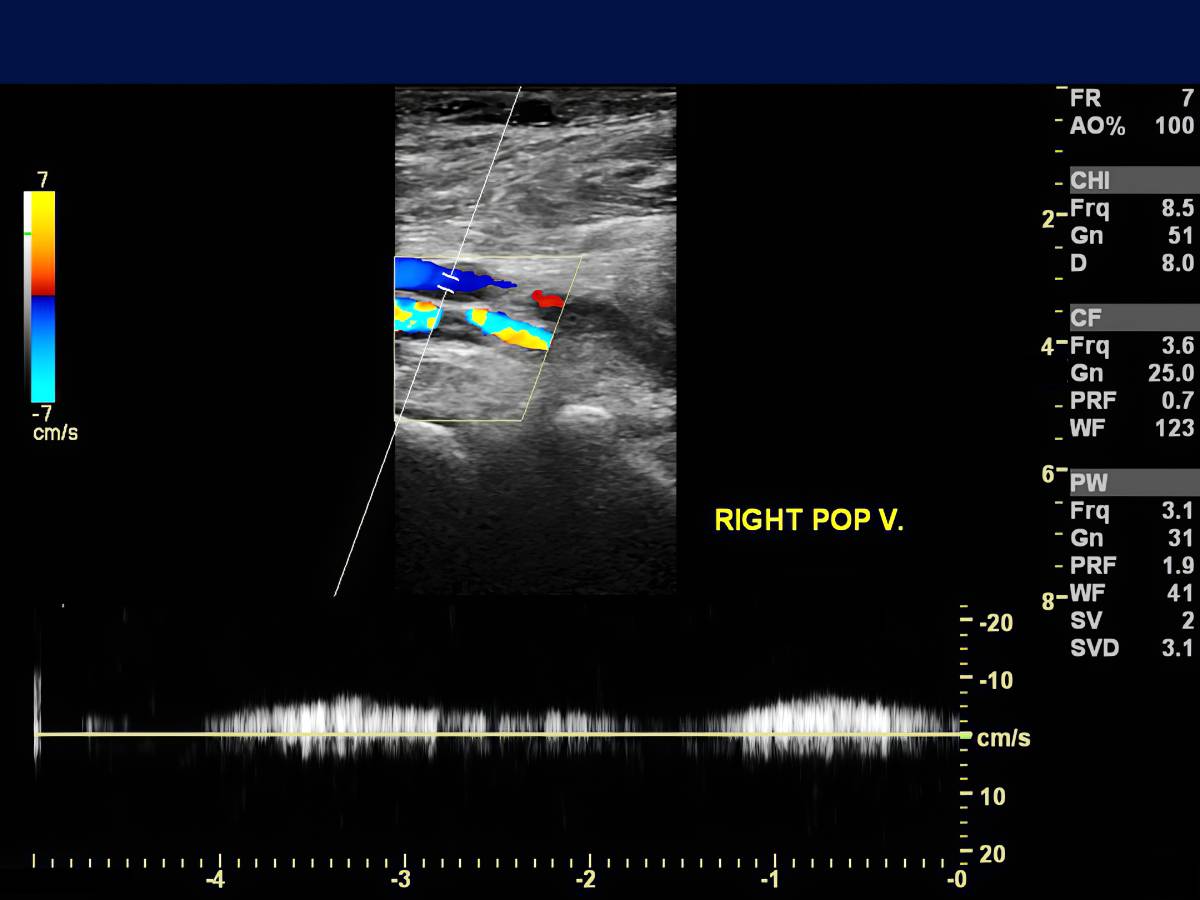 Quantitative vs. Qualitative Neuromuscular Monitoring