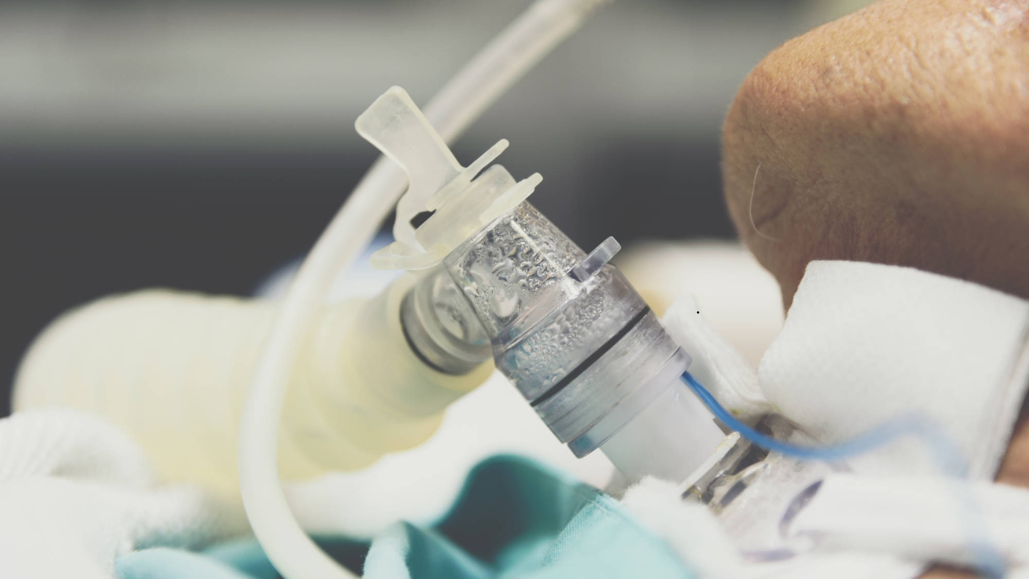 Intraoperative Airway Management with a Tracheostomy Tube